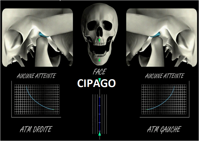 2010 – Traitement des dysfonctionnements temporo-mandibulaires par protocoles synergiques gouttières / chaînes musculaires