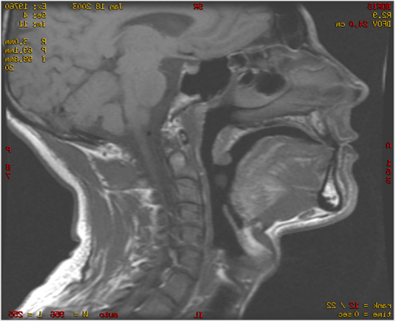 2011 – Les orthèses d’avancée mandibulaire