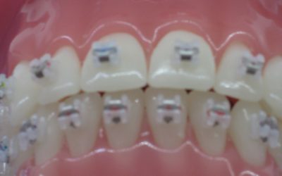 2019 – Que faire en cas d’urgence orthodontique ? Que faire en cas d’irritation ou de blessure dans la bouche ?